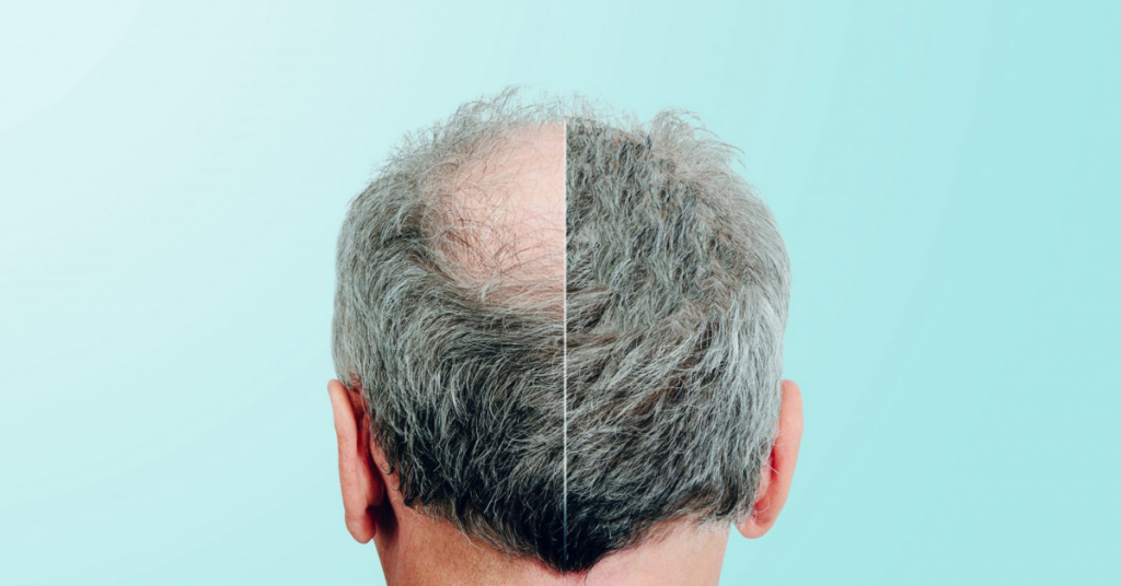Everything You Need To Know Hair Transplant Surgery In Malaysia & Where To Get Them