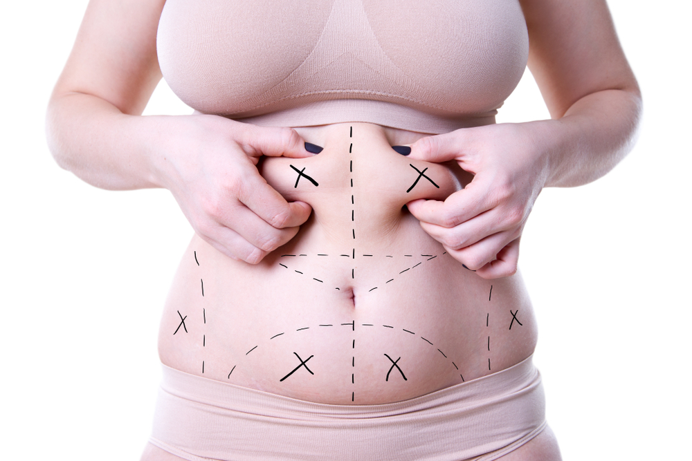 fat liposuction clinics in malaysia