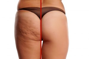 Cellulite Treatments in Malaysia
