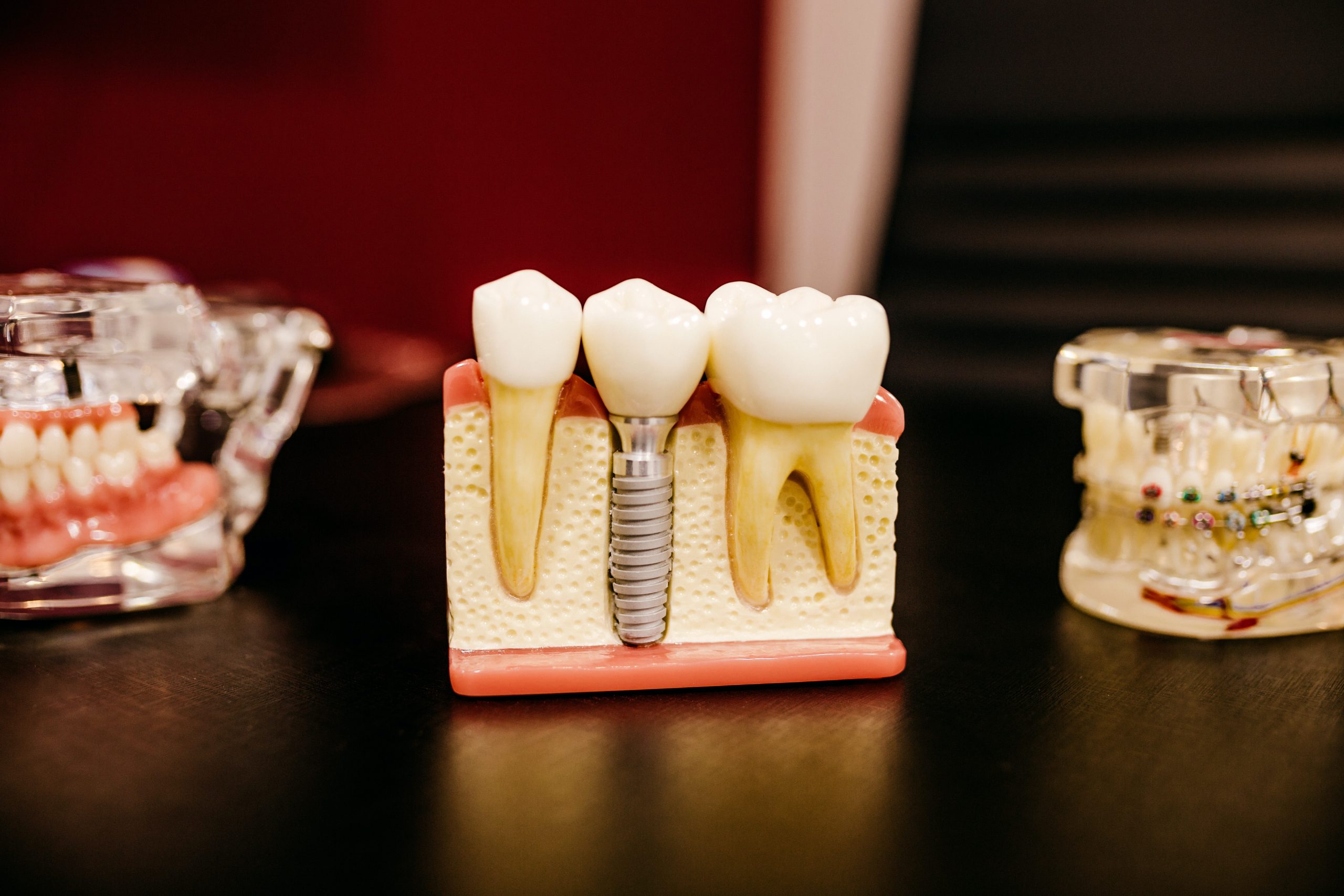 Dental Implants Everything You Need To Know And 10 Clinics In Malaysia That Offer Them