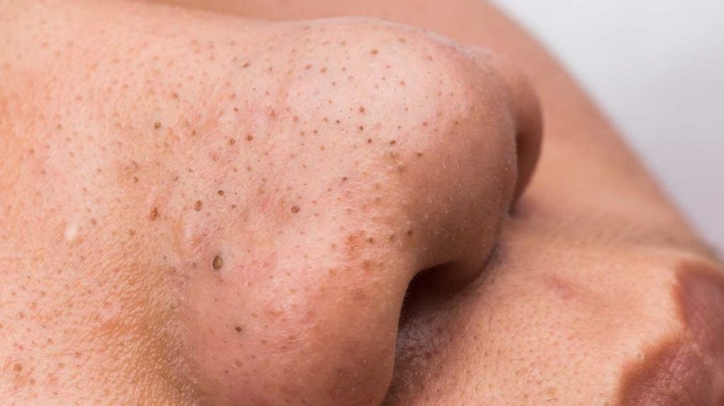 Blackheads or Clogged Pores? Get Rid of Them Now!