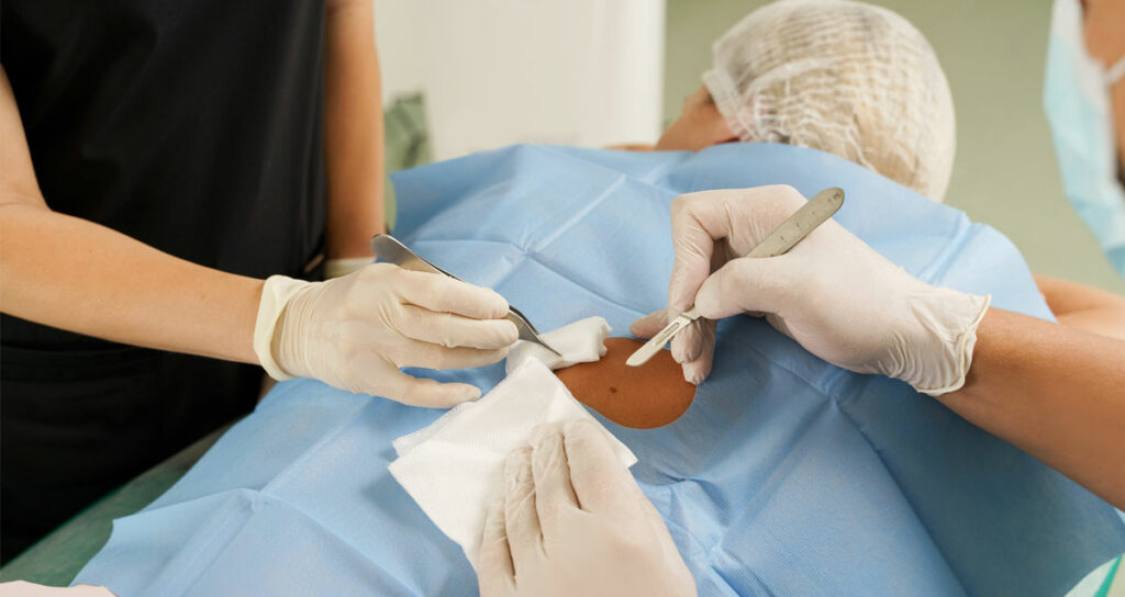 mole removal procedures
