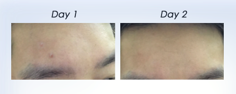 DR.WU results eliminates acne before & after